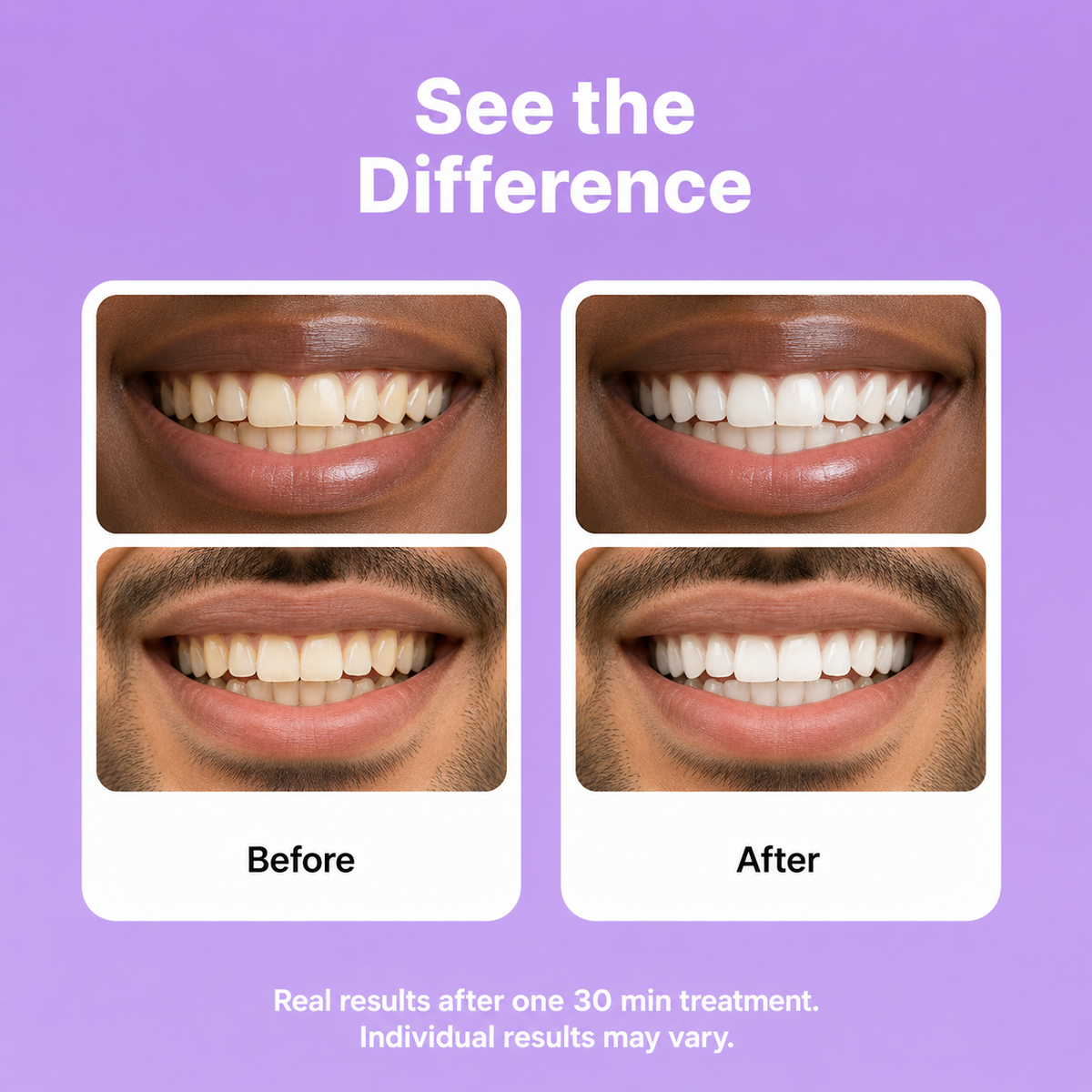 Purple Whitening Strips: Visibly Whiter in One Use